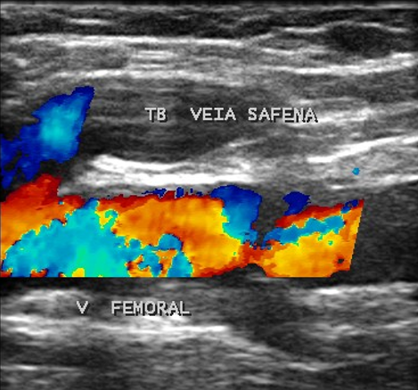 Caracterización del trombo venoso mediante ecografía vascular